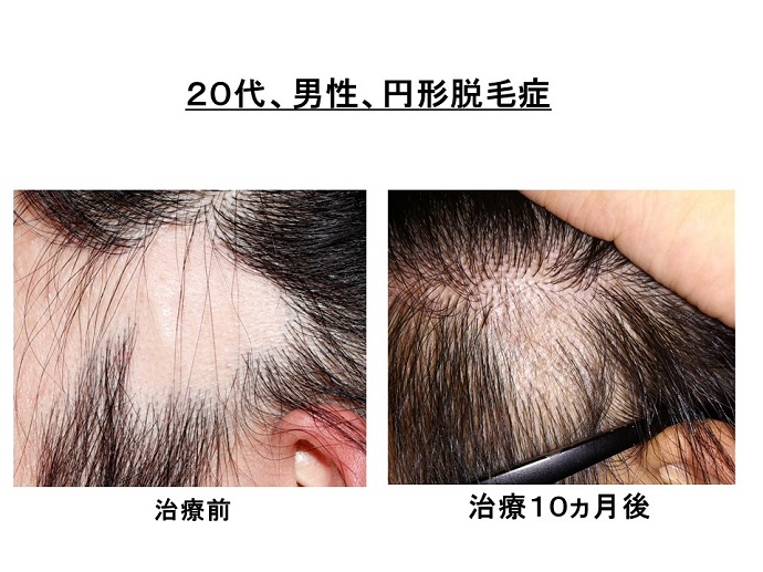 円形脱毛症　病院